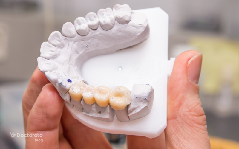 معایب کاشت دندان بدون ایمپلنت چیست؟