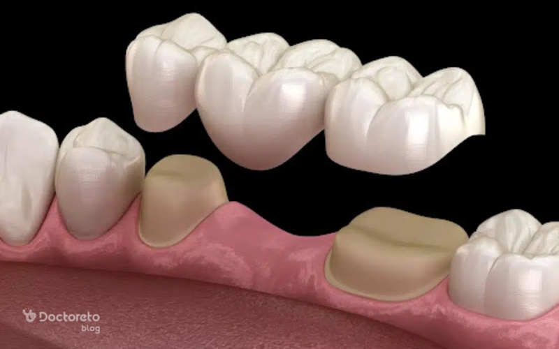 انواع روش کاشت دندان بدون ایمپلنت چیست؟