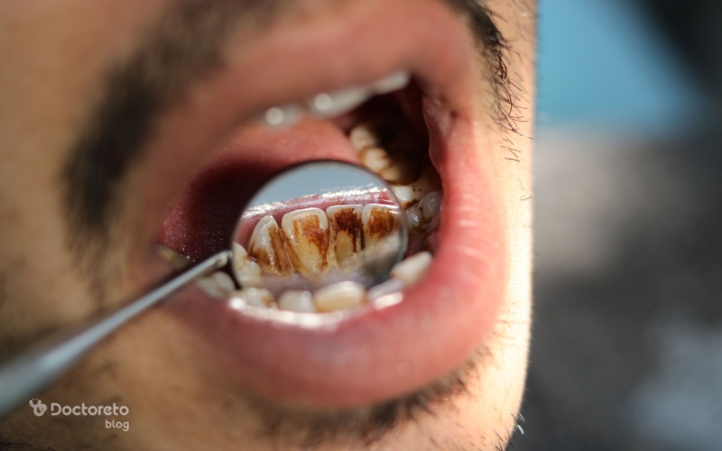 سیگار کشیدن و زرد شدن دندان مرتبط هستند؟