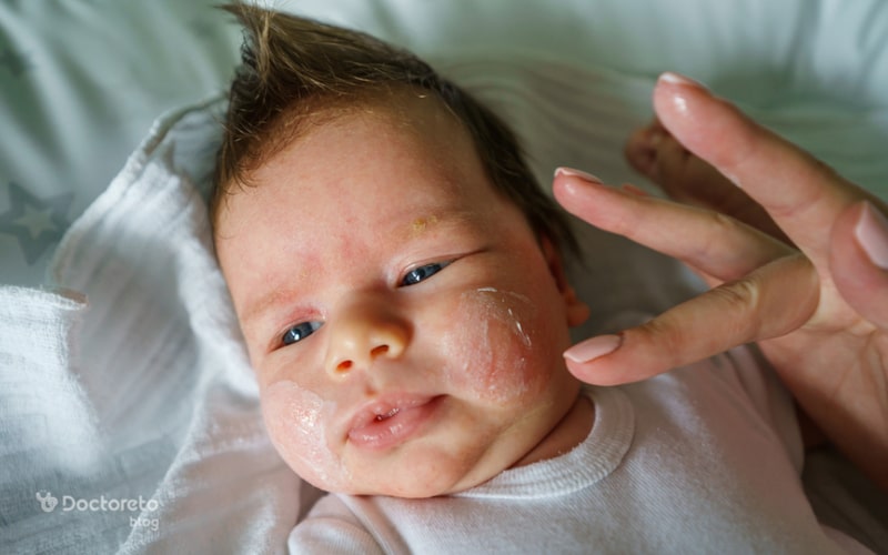درماتیت آتوپیک در نوزادان هم ایجاد میشود.