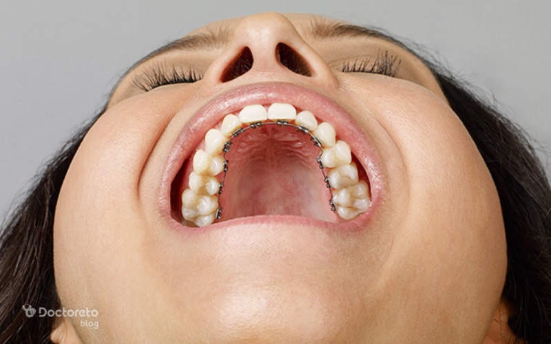 درد کمتر ارتودنسی پشت دندانی حقیقت دارد؟