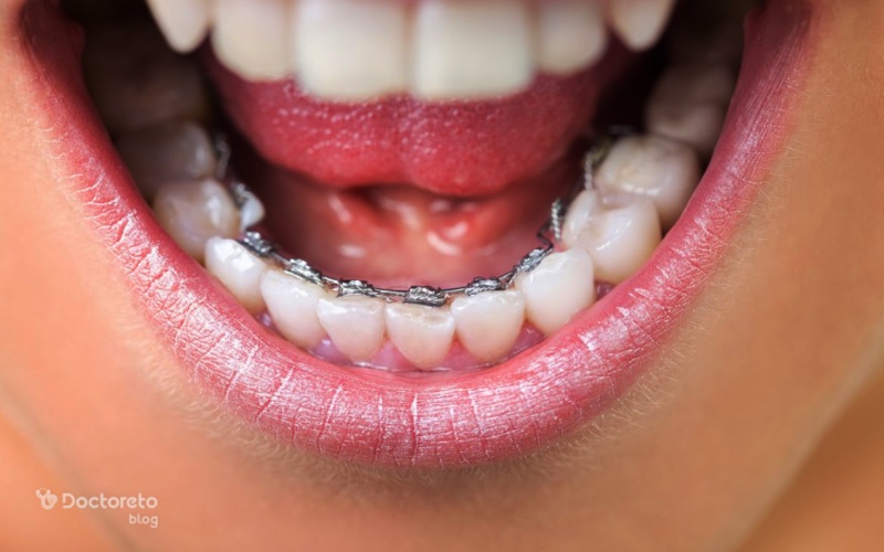 روش ارتودنسی لینگوال و مزایای ارتودنسی پشت دندانی چیست؟