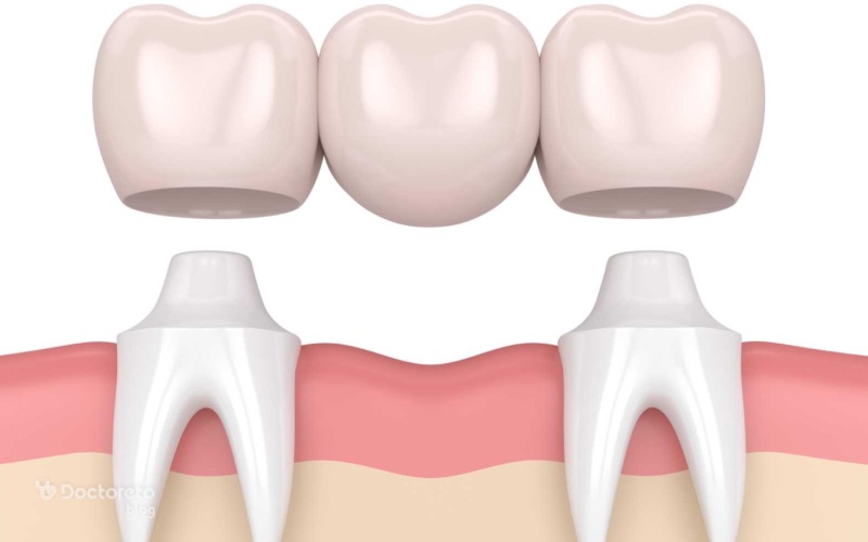 مشکلات و معایب بریج دندان چیست؟