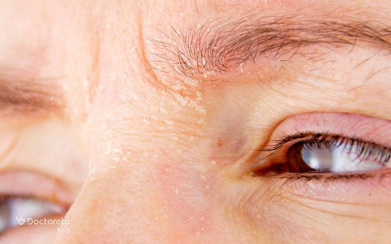 درمان درماتیت صورت با مرطوب کردن پوست ممکن است.
