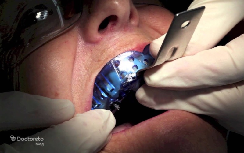 انواع روش قالب گیری ایمپلنت دندان کدام است؟