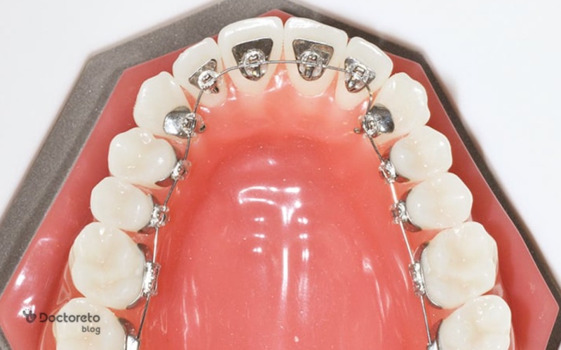 ارتودنسی نامرئی لینگوال یا ارتودنسی از پشت دندان چیست؟