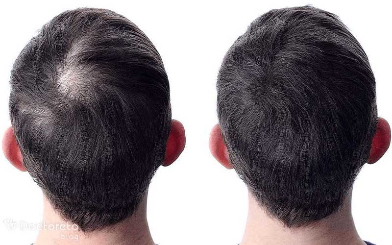 کاشت مو و مزوتراپی برای تقویت مو همزمان انجام می شوند.