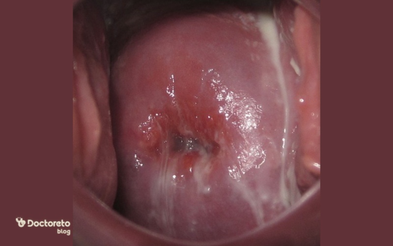 عکس عفونت در بارداری