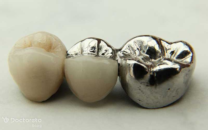 روکش استیل دندان شیری به افزایش مقاومت دندان کمک می کند.