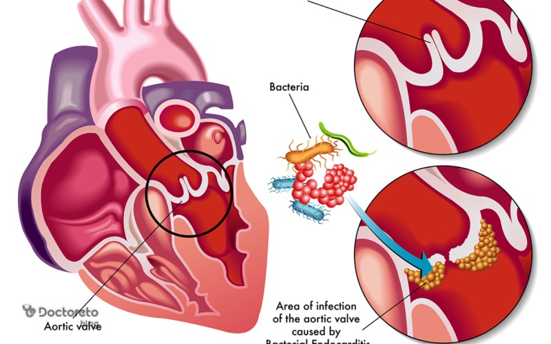 التهاب دور قلب چیست؟