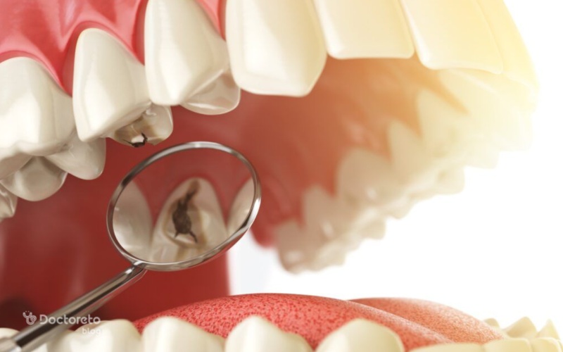  پوسیدگی دندان روکش دار چگونه است؟