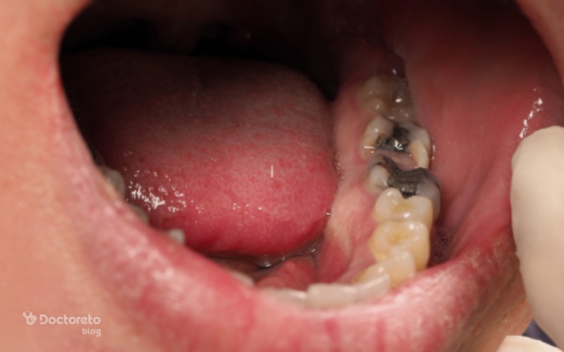 پوسیدگی دندان بعد از عصب کشی چرا رخ میدهد؟