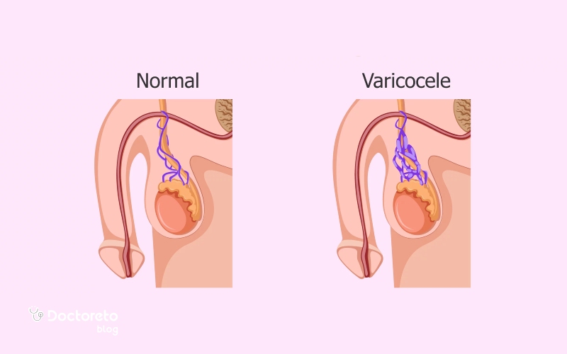 علت واریکوسل چیست؟