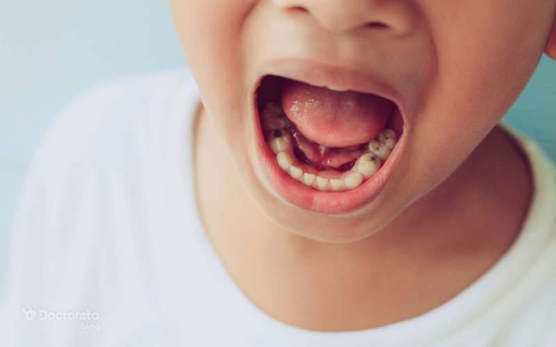 پوسیدگی دندان کودکان چگونه است؟