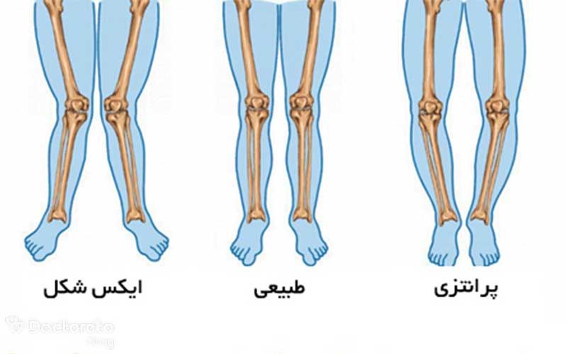 تصویر انواع مشکلات پای پرانتزی و ایکس شکل را مشاهده می کنید.