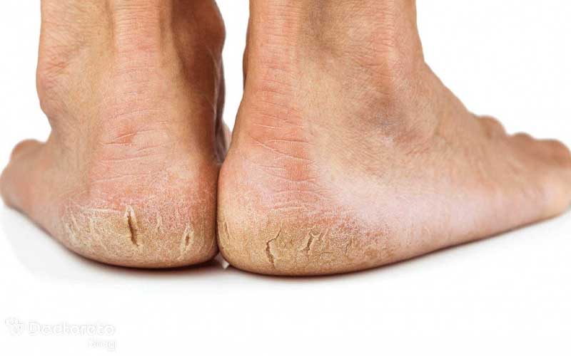 لایه برداری و استفاده از سنگ پا برای درمان ترک پا خوب است.