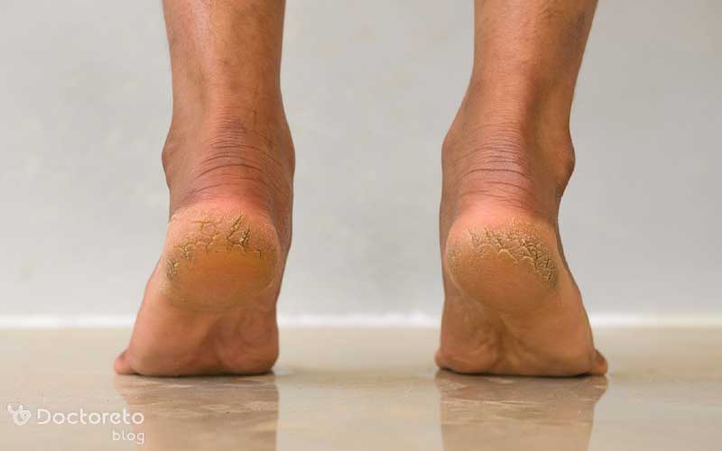 روغن های مختلفی به درمان رفع ترک پا کمک می کنند.