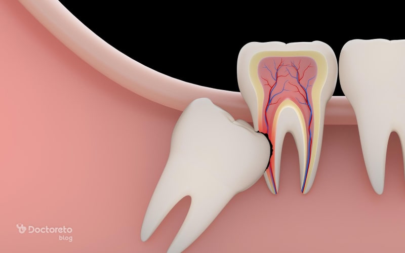 دندان عقل چند تاست؟