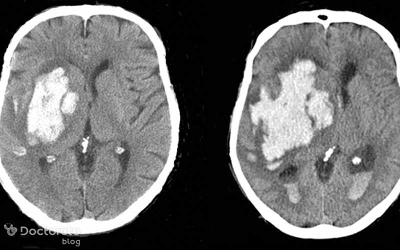 عکس سی تی اسکن خونریزی مغزی چگونه است؟