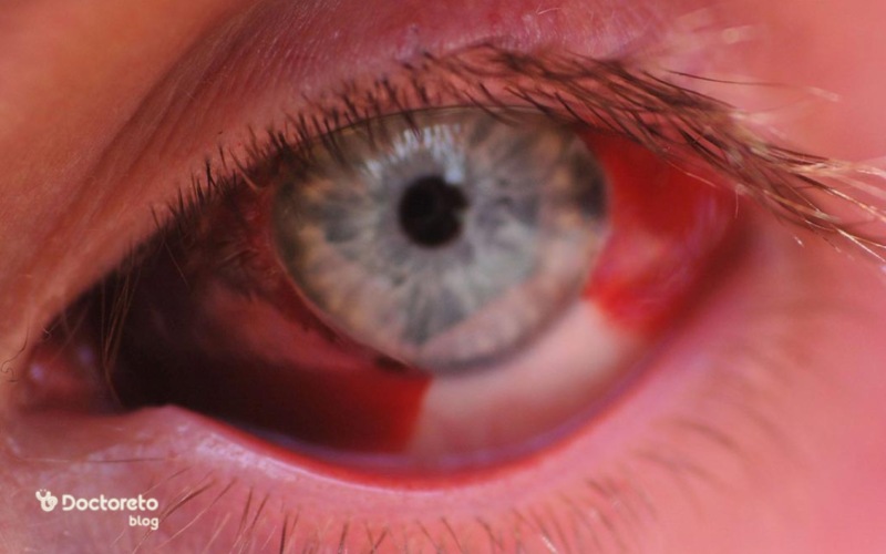 خطر آسیب عصبی چشم با قرص ویتامین بی 12
