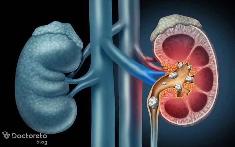 عمل سنگ کلیه چگونه انجام می شود؟