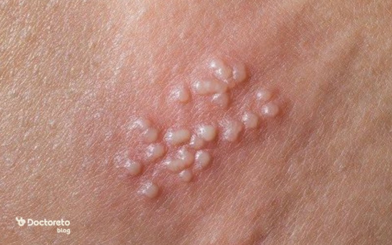 عکس ضایعات چندتایی زگیل تناسلی