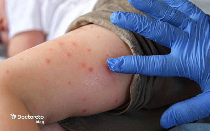 عکس نیش پشه آئدس