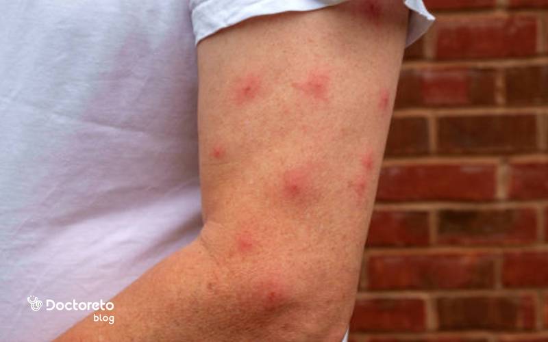 علائم پوستی تب دنگی