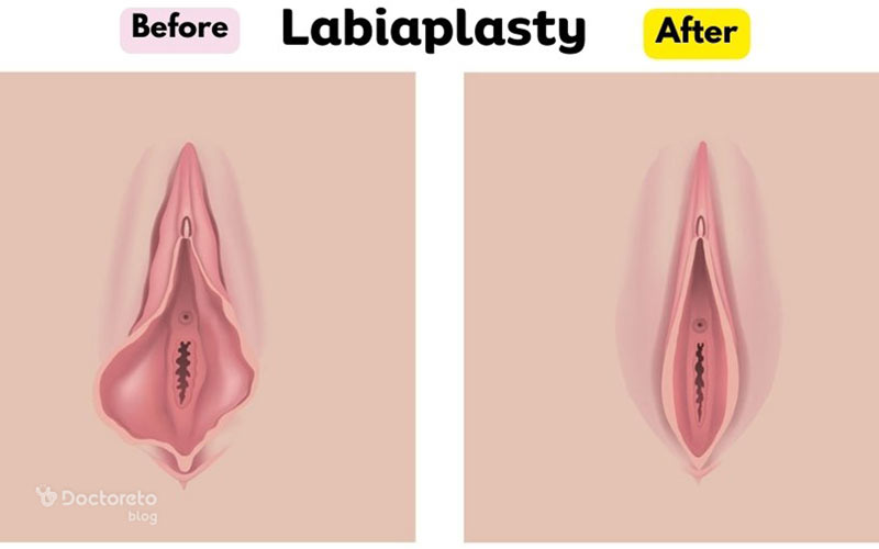 قبل و بعد عمل لابیاپلاستی بسیار متفاوت است.