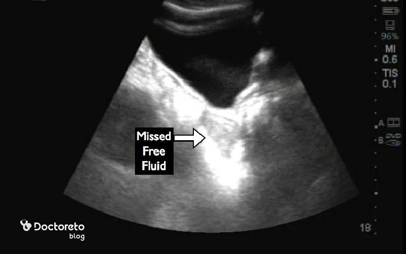 سونوگرافی مایع آزاد در لگن