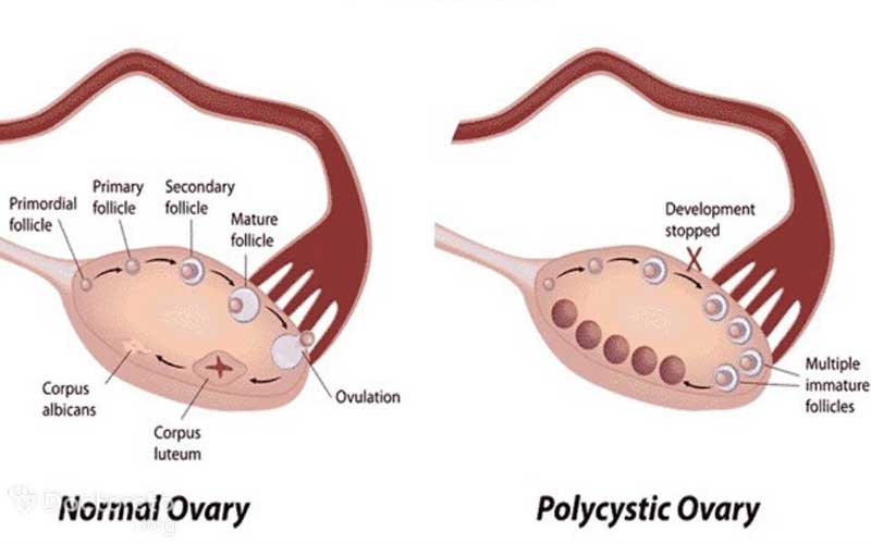 راه درمان تنبلی تخمدان چیست؟