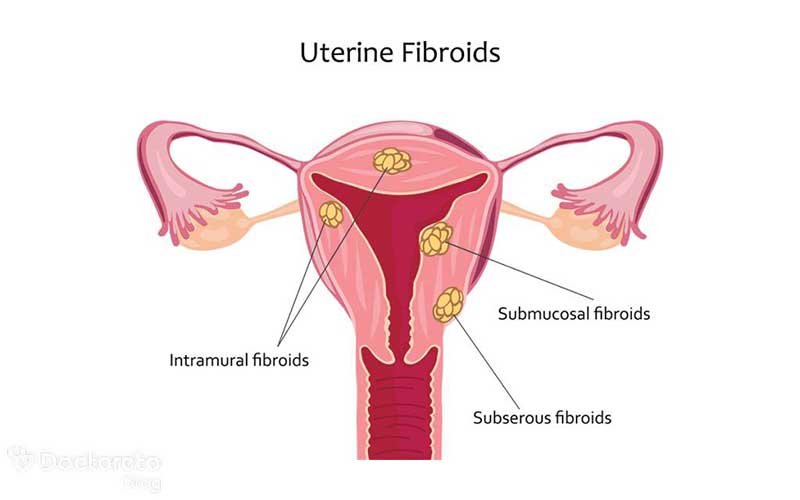 فیبروم رحم چه شکلی است؟