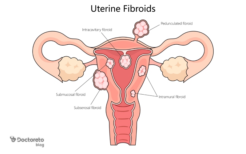 موقع الأورام الليفية الرحمية أثناء الحمل