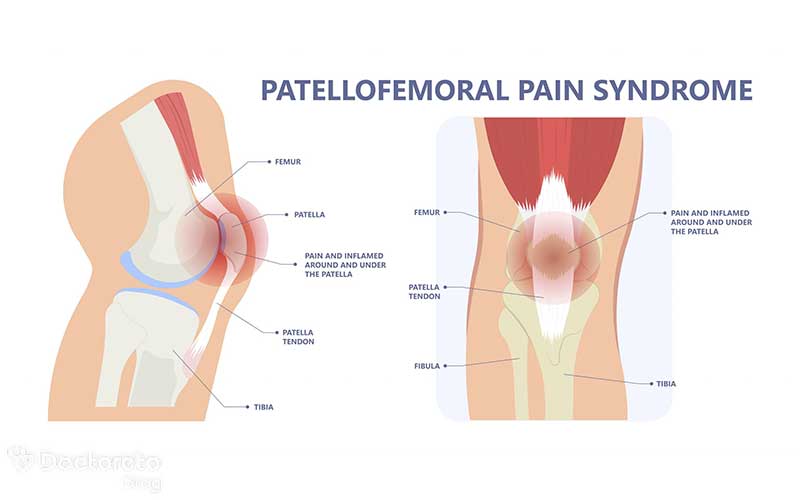 سندرم درد پاتلوفمورال چیست؟