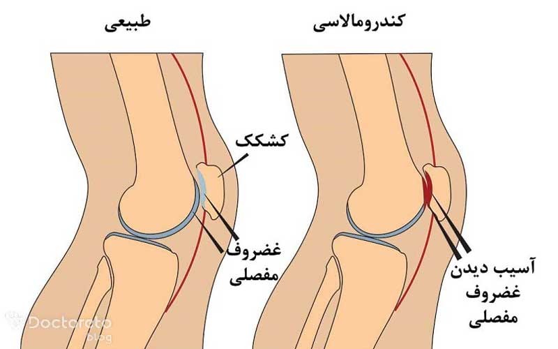 تصویر نرمی کشکک زانو نشان دهنده چه چیزی است؟