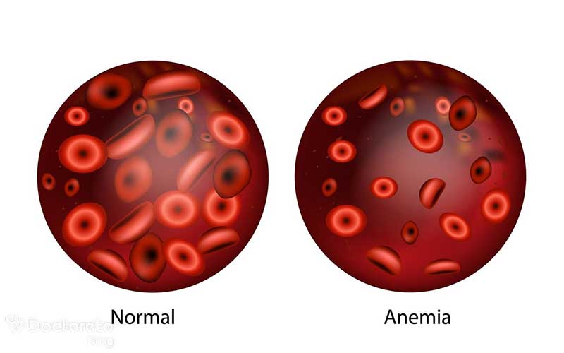 علائم کم خونی چیست؟