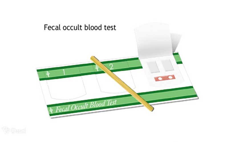 تصویری از نمونه آزمایش خون مخفی مدفوع