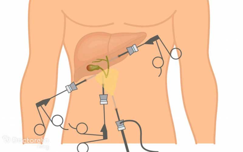 لاپاراسکوپی کیسه صفرا چه روشی است؟