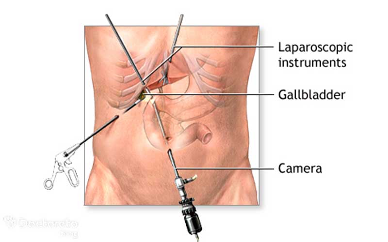 لاپاراسکوپی کیسه صفرا چیست؟