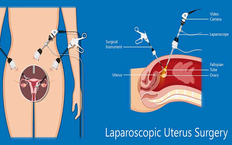 لاپاراسکوپی رحم چه روشی است؟