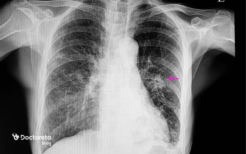 از کجا بفهمیم ریه عفونت کرده است؟