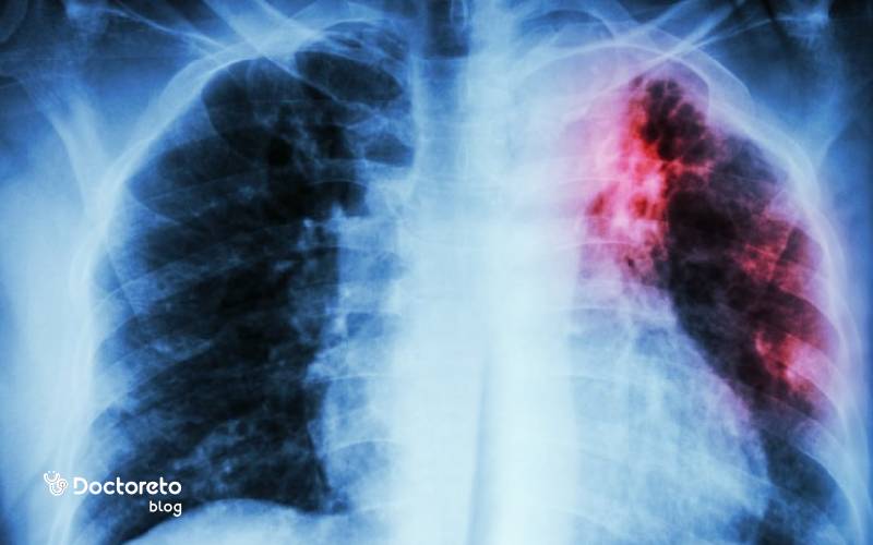 بهترین آمپول برای عفونت ریه