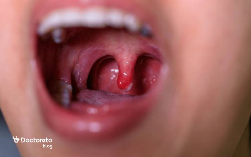 علت عفونت لوزه چیست؟