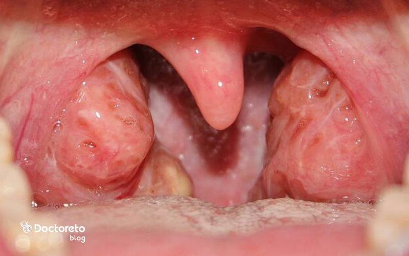 عکس عفونت لوزه در بزرگسالان