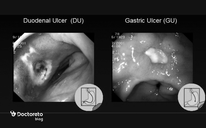 تشخیص زخم دوازدهه با آندوسکوپی و عکس زخم اثنی عشر امکانپذیر است.