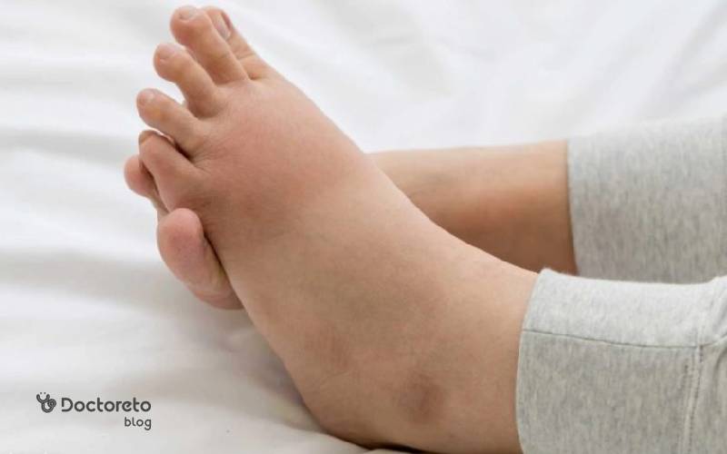 علائم ورم پا بعد از زایمان