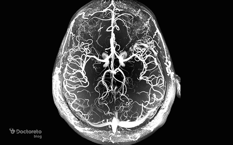 آنژیوگرافی مغز چه نوع روشی است؟