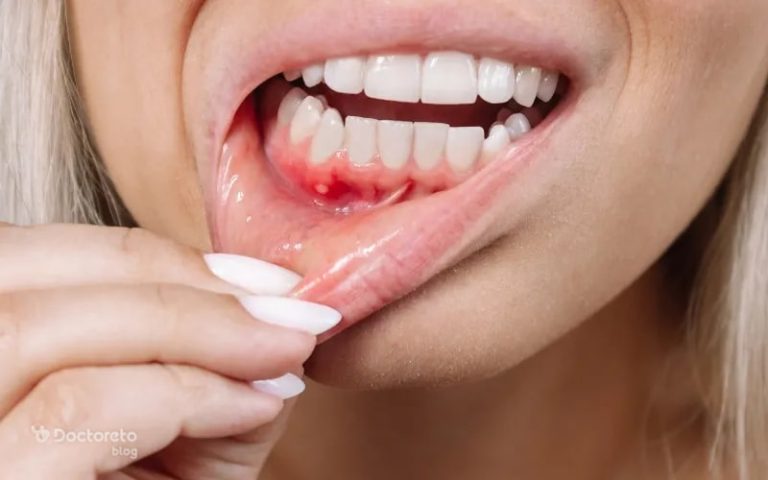 بهترین درمان خانگی زخم دهان چیست؟ معرفی ۱۶ درمان موثر