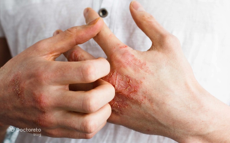 علائم اگزما چیست و چگونه نشانه های اگزما را تشخیص دهیم؟