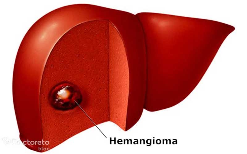 همانژیوم کبدی (توده کبدی) چیست؟